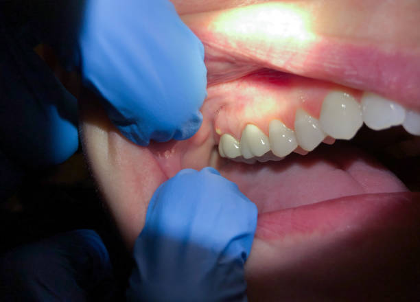 Best Emergency Gum Treatment in Colby, KS